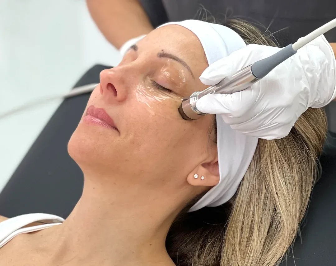 Radiofrequency Facial (RF)