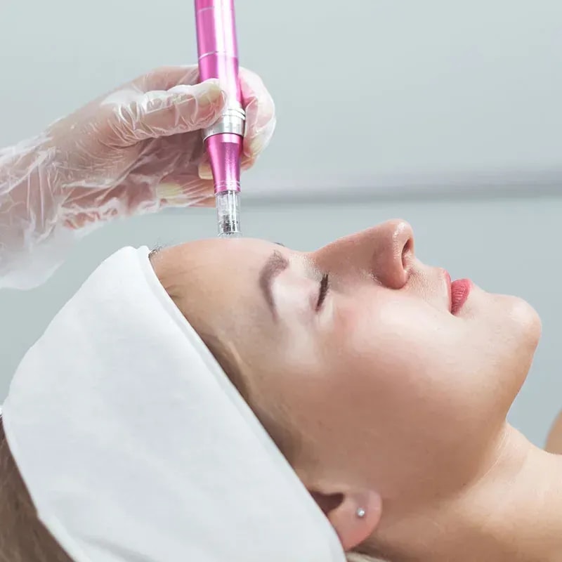 RF microneedling treatment applied to patient's face during professional aesthetic procedure